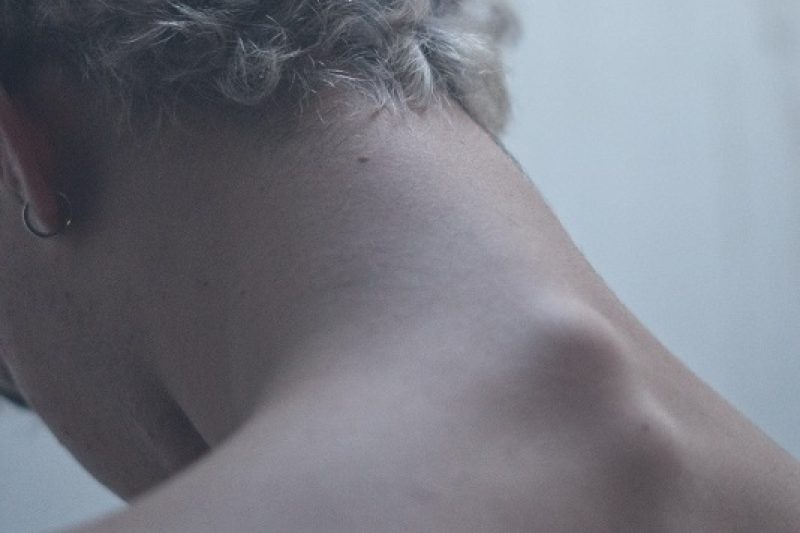 What is Cervical Disc Degeneration?